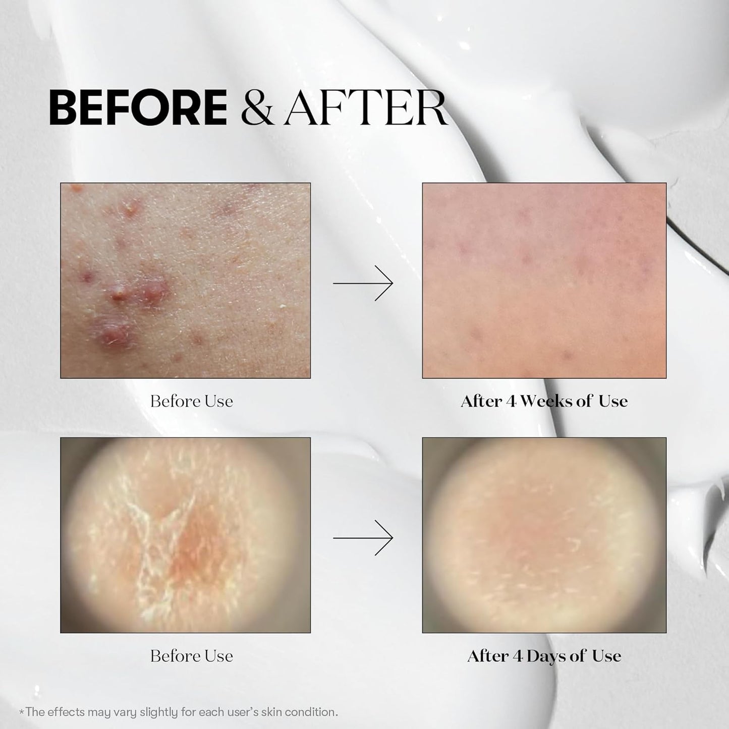 VT COSMETICS CICA Reedle Shot 100, suero de microagujas para cuidado de poros y exfoliación, exosoma