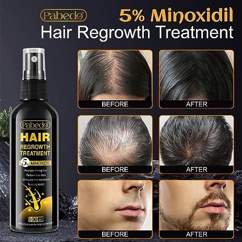 Suero de crecimiento del cabello de minoxidil al 5%, spray d